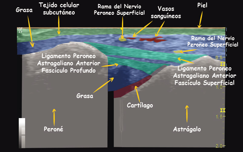 caso-cl-nico-ligamento-peroneo-astragalino-anterior-tempo-formaci-n